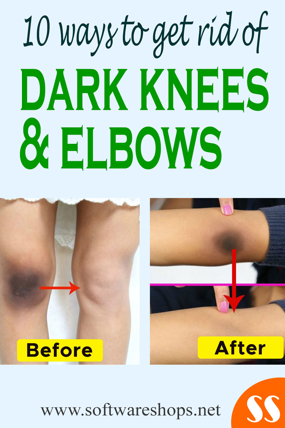 get rid of dark knees and elbows