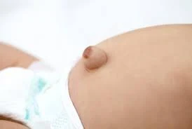 hernia pusat,pusat baby terkeluar semasa dilahiran,hernia,berak lebih 10 kali malam