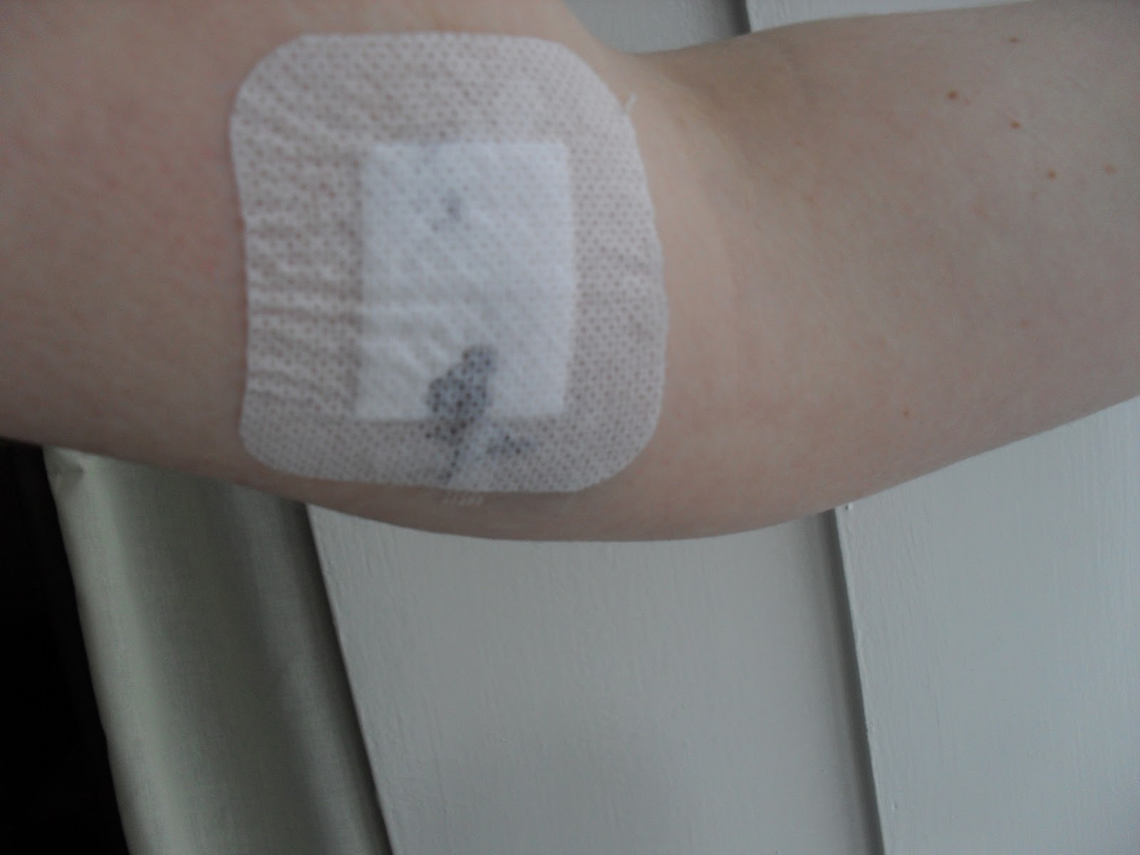 My experience with Nexplanon (contraceptive implant)