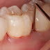 Viêm chân răng là gì?