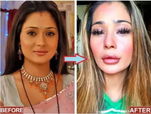 Sara Khan Lip surgery pic