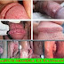 OBAT Kutil kelamin ONLINE thumbnail