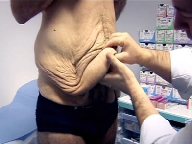 Cirugia bariatrica perdida de peso
