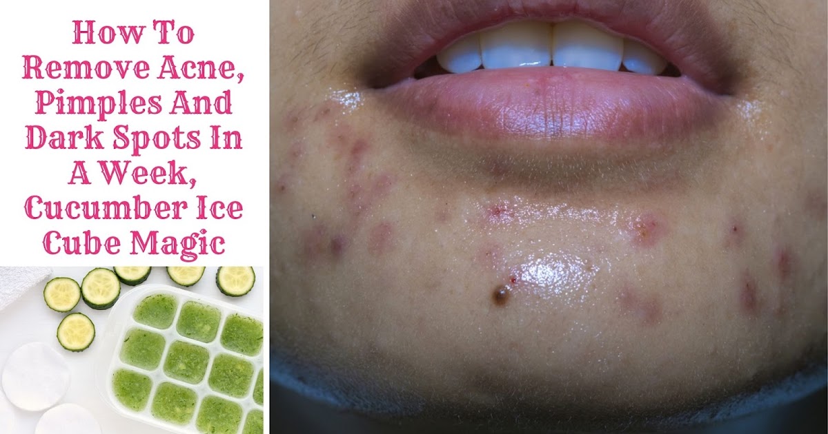 How To Remove Acne, Pimples And Dark Spots In A Week, Cucumber Ice Cube Magic Makeup Vine