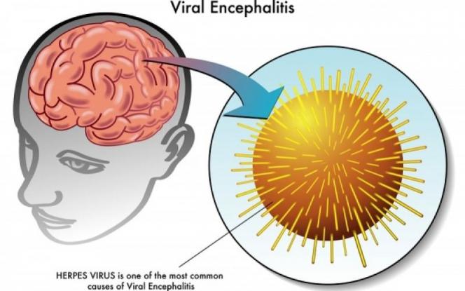Εγκεφαλίτιδα: Από τι προκαλείται και πώς αντιμετωπίζεται