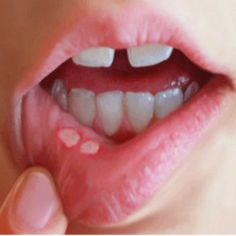 Viral Oral Ulcer Diet