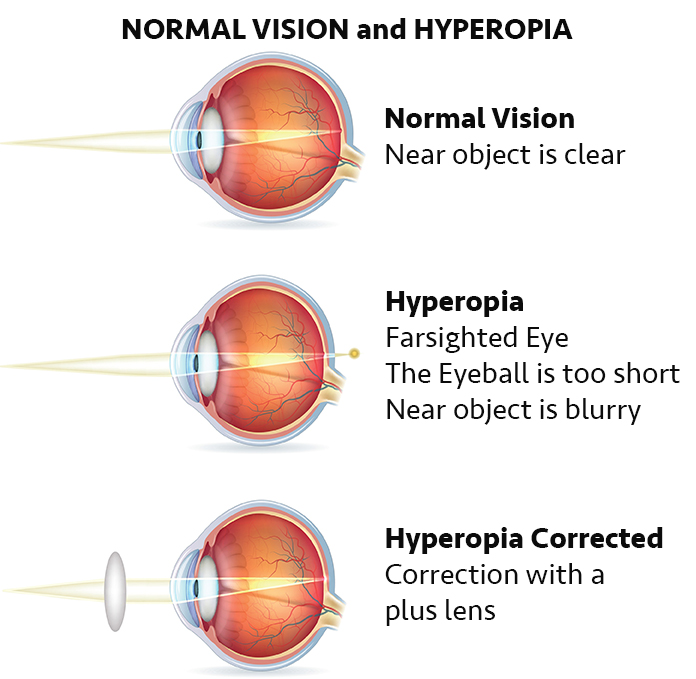 what causes refractive errors in the eye