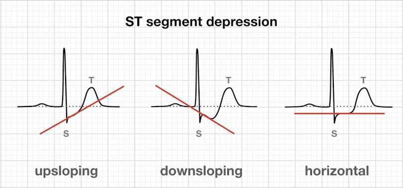 Gambaran Abnormal dan Perubahan Morfologi Pada Gelombang EKG | Portal