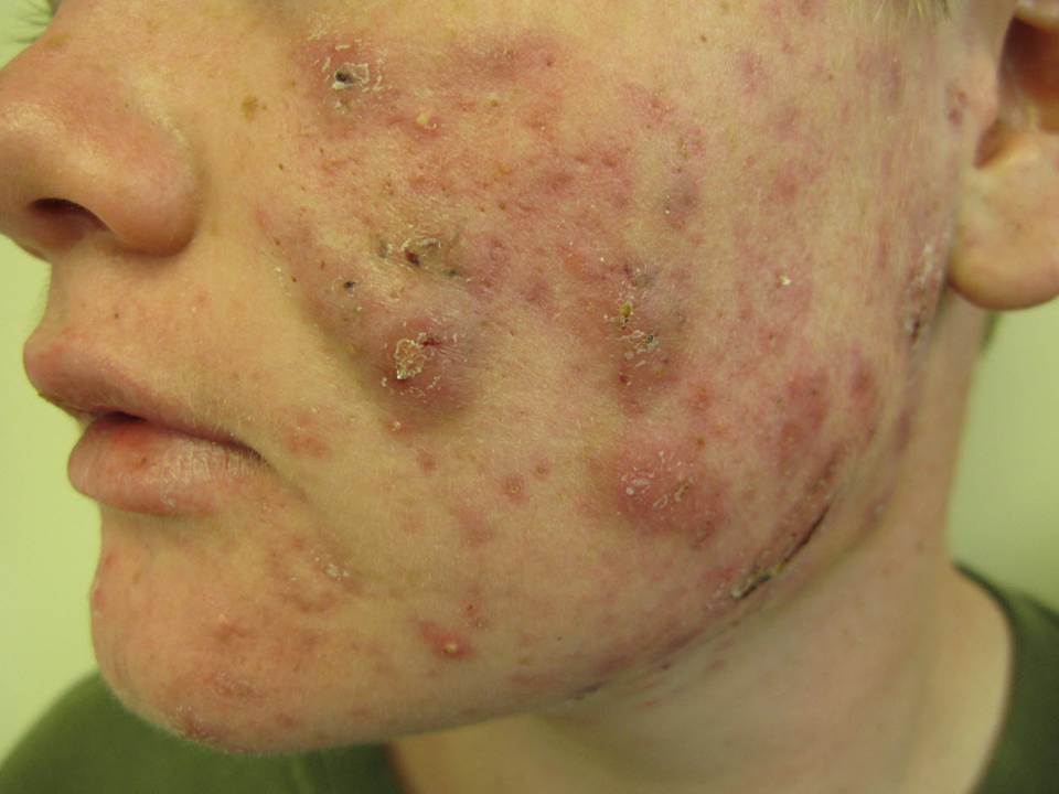 Hidradenitis Suppurativa Pics Pictures Photos