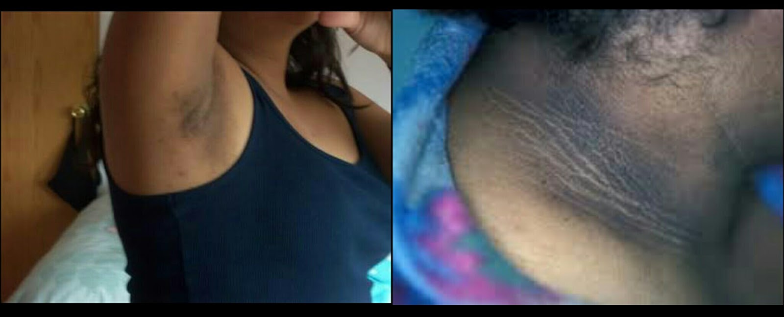 Welcome To Dashy S Blog Home Remedy For Dark Neck Armpits And