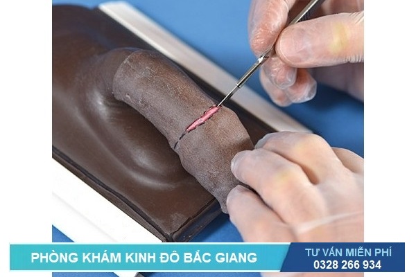 Cắt bao quy đầu ở Bắc Giang