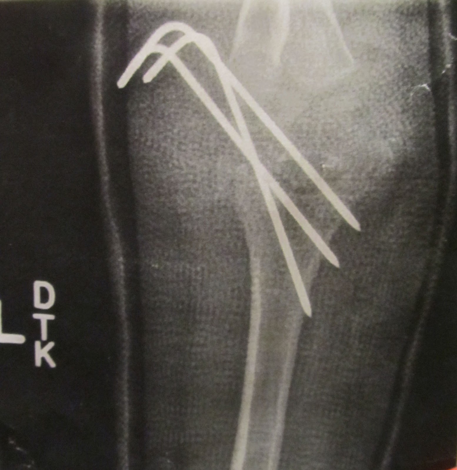 life with 4 kiddos broken bones