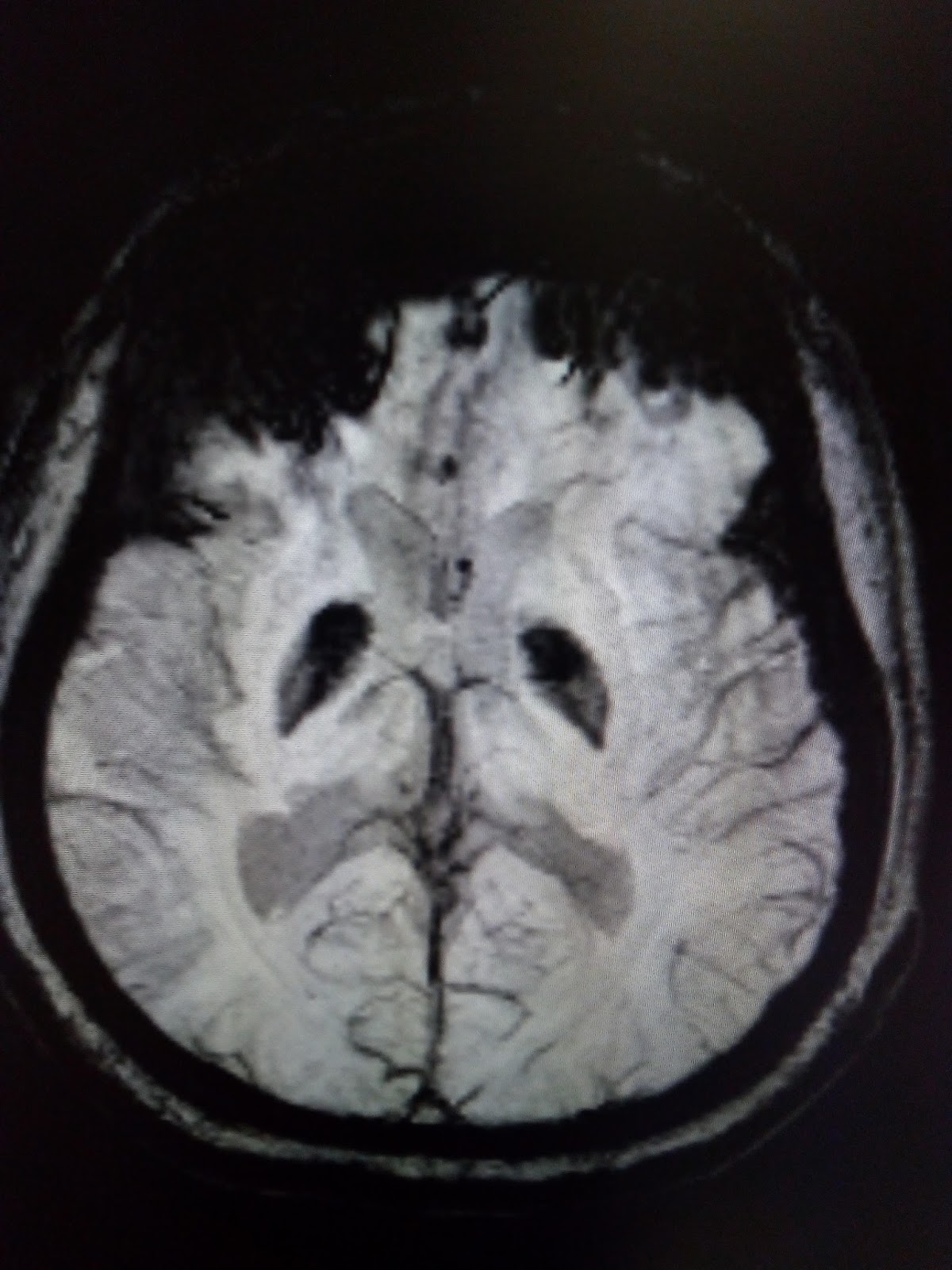 Neurodegeneration with Brain Iron Accumulation (NBIA) MRI Sumer's