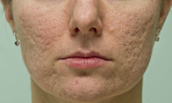 How to Treat Acne - Perform All Things