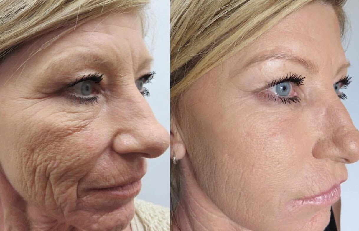 Shop Suddenly Slimmer How Can I Tighten Sagging Skin Without Surgery? Shop Suddenly Slimmer How Can I Tighten Sagging Skin Without Surgery?
