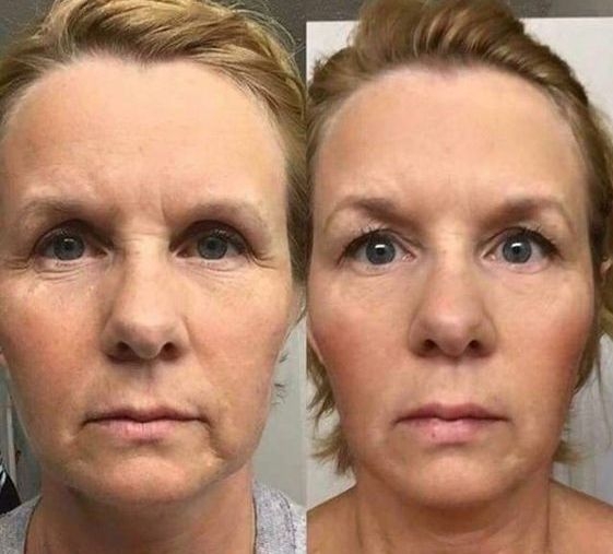 Using Facelift Workouts To Remove Lip Lines Above The Mouth