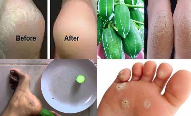 Cara Cepat Menghaluskan Tumit Kaki Pecah Cuma dengan Getah Pepaya