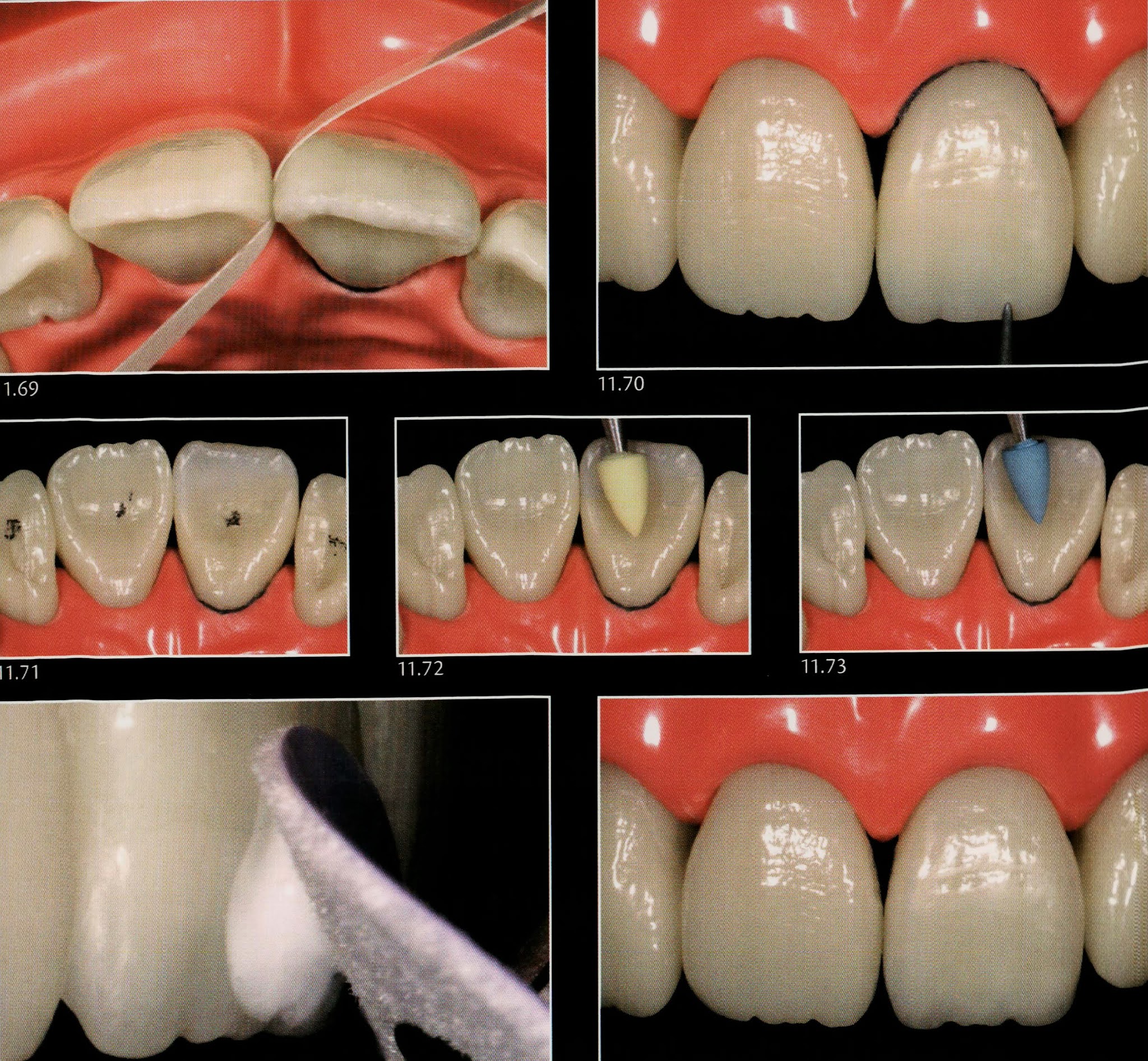 Class IV composite " silicone guide technique " Dental Esthetics