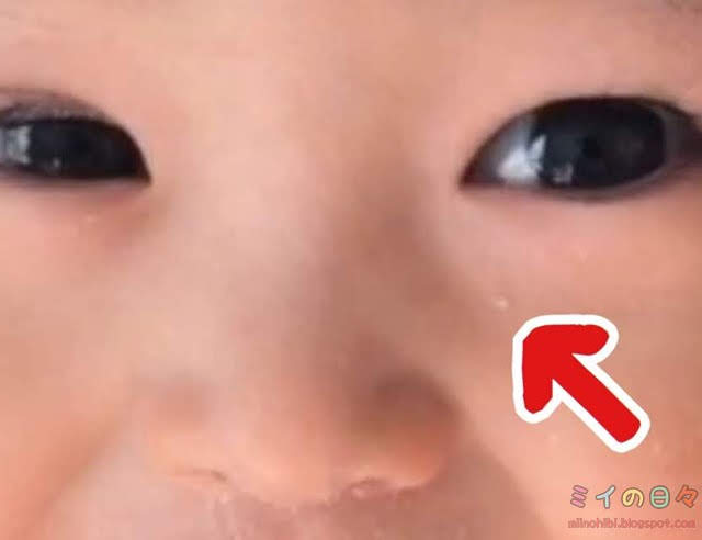 赤ちゃんの顔にできた白いポツポツの正体は稗粒腫（はいりゅうしゅ）ミイの日々