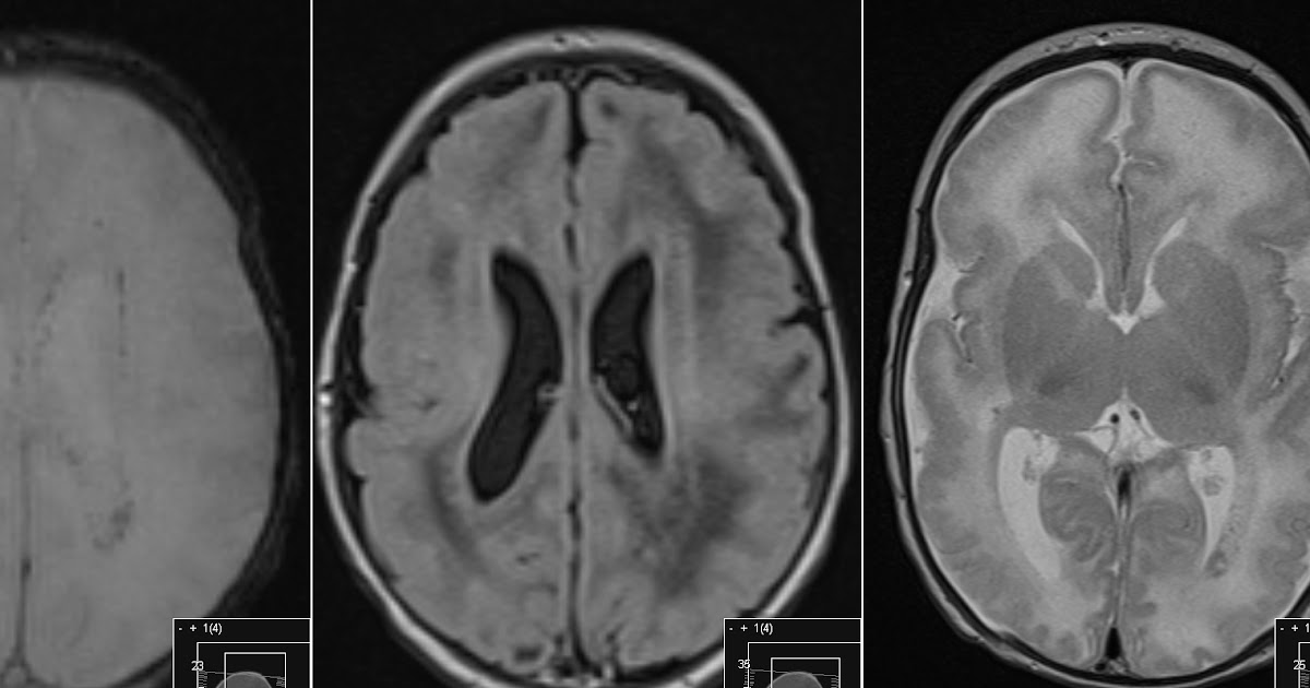 Radiology MRI Congenital Cytomegalovirus Infection Radiology MRI Congenital Cytomegalovirus Infection