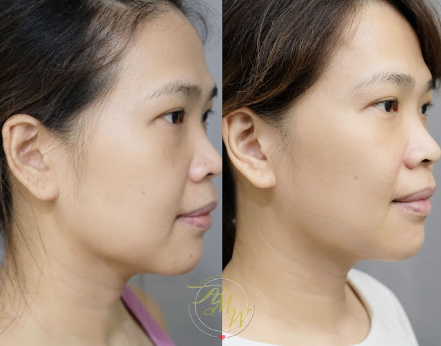 before and after photo of FOREO UFO Review with before and after photo of skin