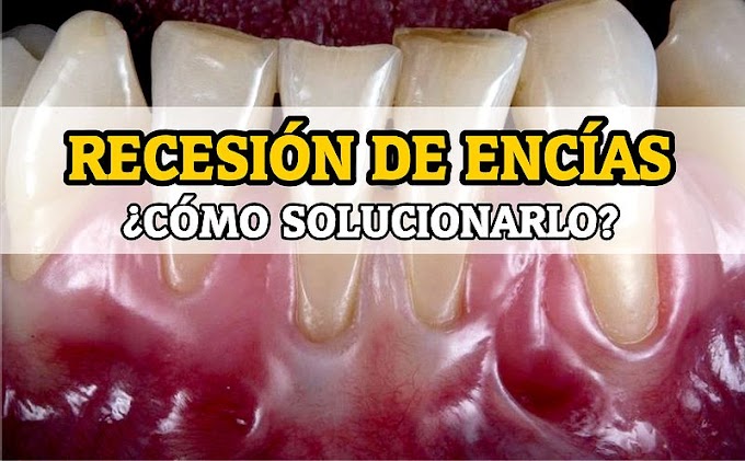 RECESIÓN DE ENCÍAS: ¿Cómo solucionarlo? - Dr. Cuevas Queipo