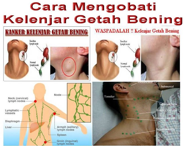 Pengobatan Ampuh Untuk Sembuhkan Kanker Kelenjar Getah Bening Pengobatan Ampuh Untuk Sembuhkan Kanker Kelenjar Getah Bening