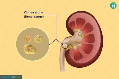 kidney stone-renal stone kidney stone-renal stone