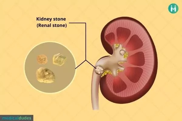 Kidney Stone: types, causes, symptoms, diagnosis, treatment