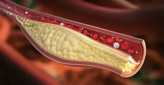 كيفية تنظيف الأوعية الدموية من الكوليسترول - العلاجات العشبية وتوصيات الأطباء