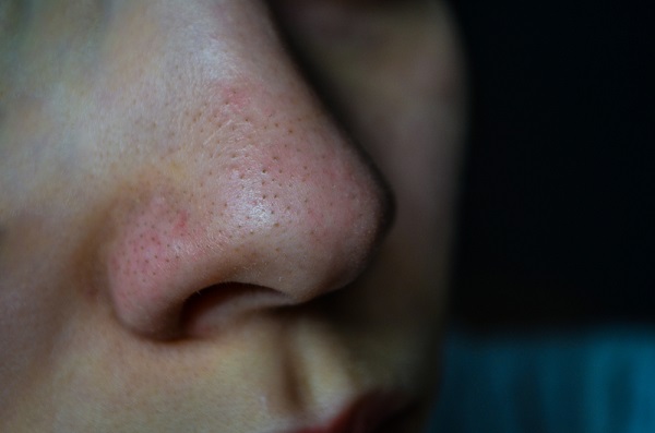 Blackhead Treatment - Try to treat blackheads naturally Blackhead Treatment - Try to treat blackheads naturally