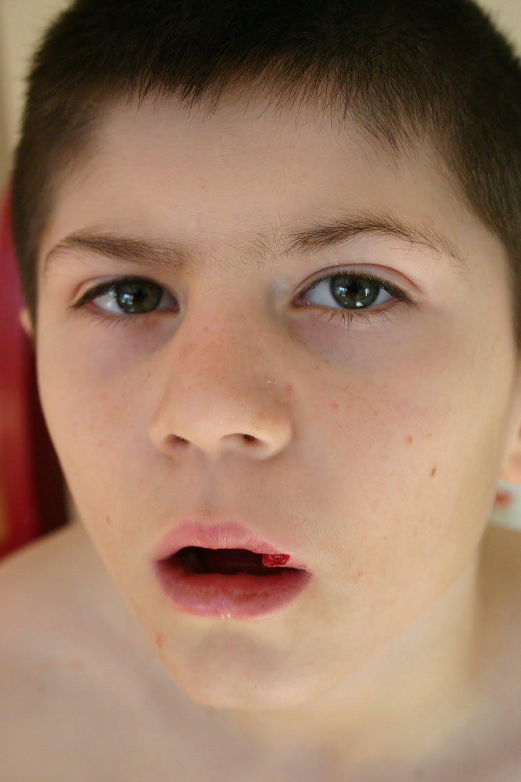 My Perspective Kyle's Busted Lip 1/22/11