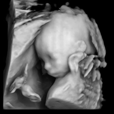 Baby Jones Update - 20 week scan 3D image