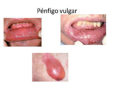 Penfigo vulgar