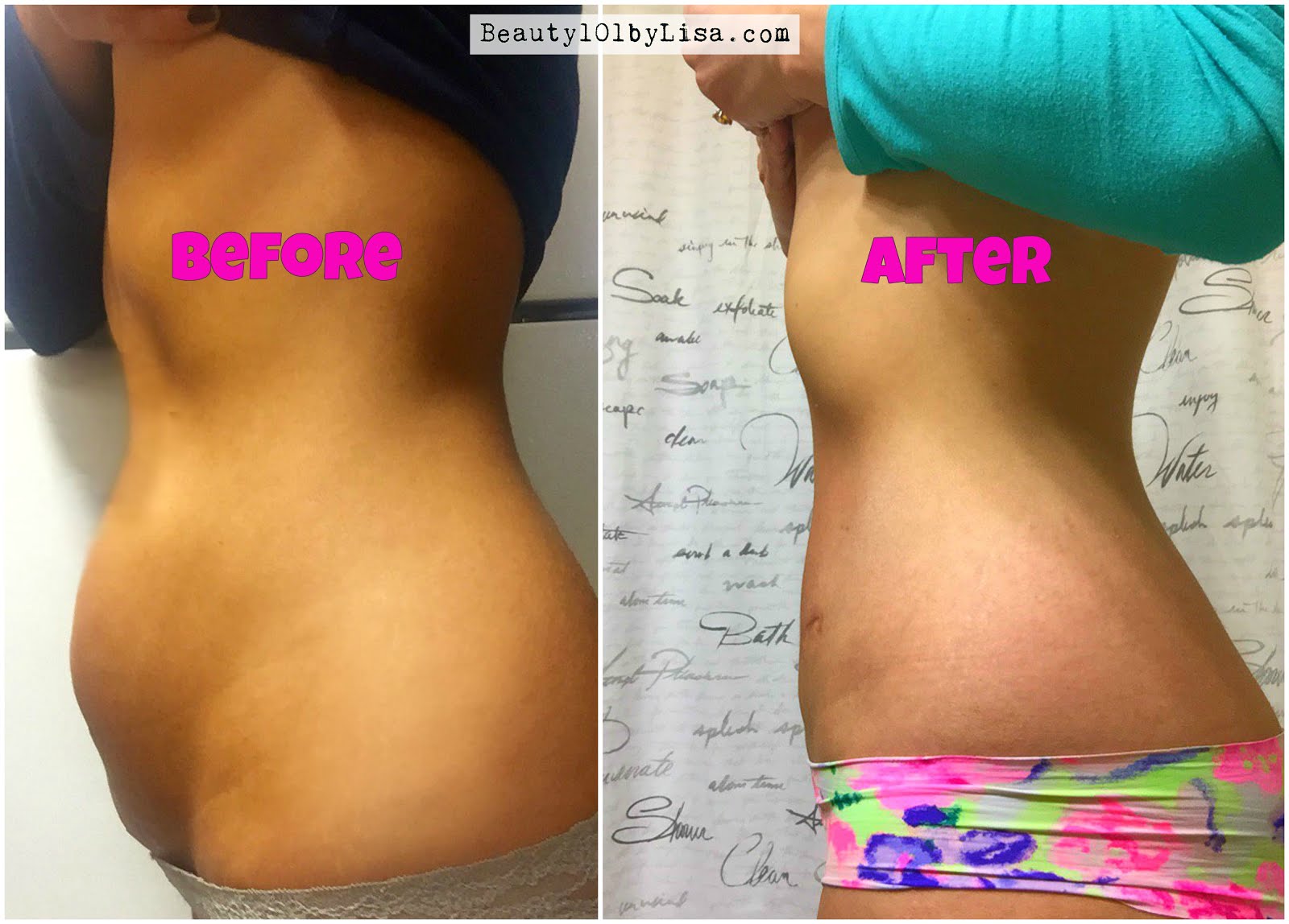 Before And After Pregnancy Hernia