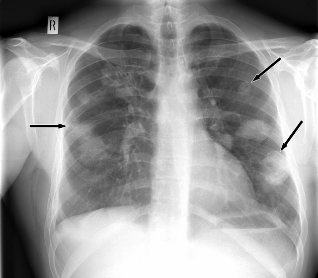 Quike & Vivi's World Wegener's Granulomatosis