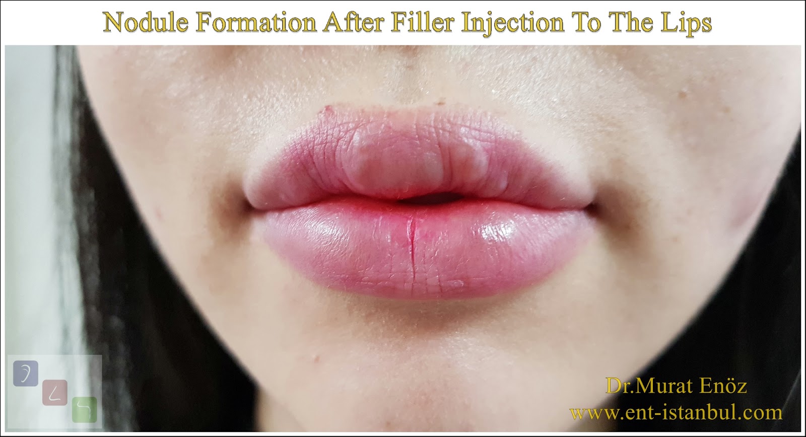 Nodule Formation After Filler Injection To The Lips