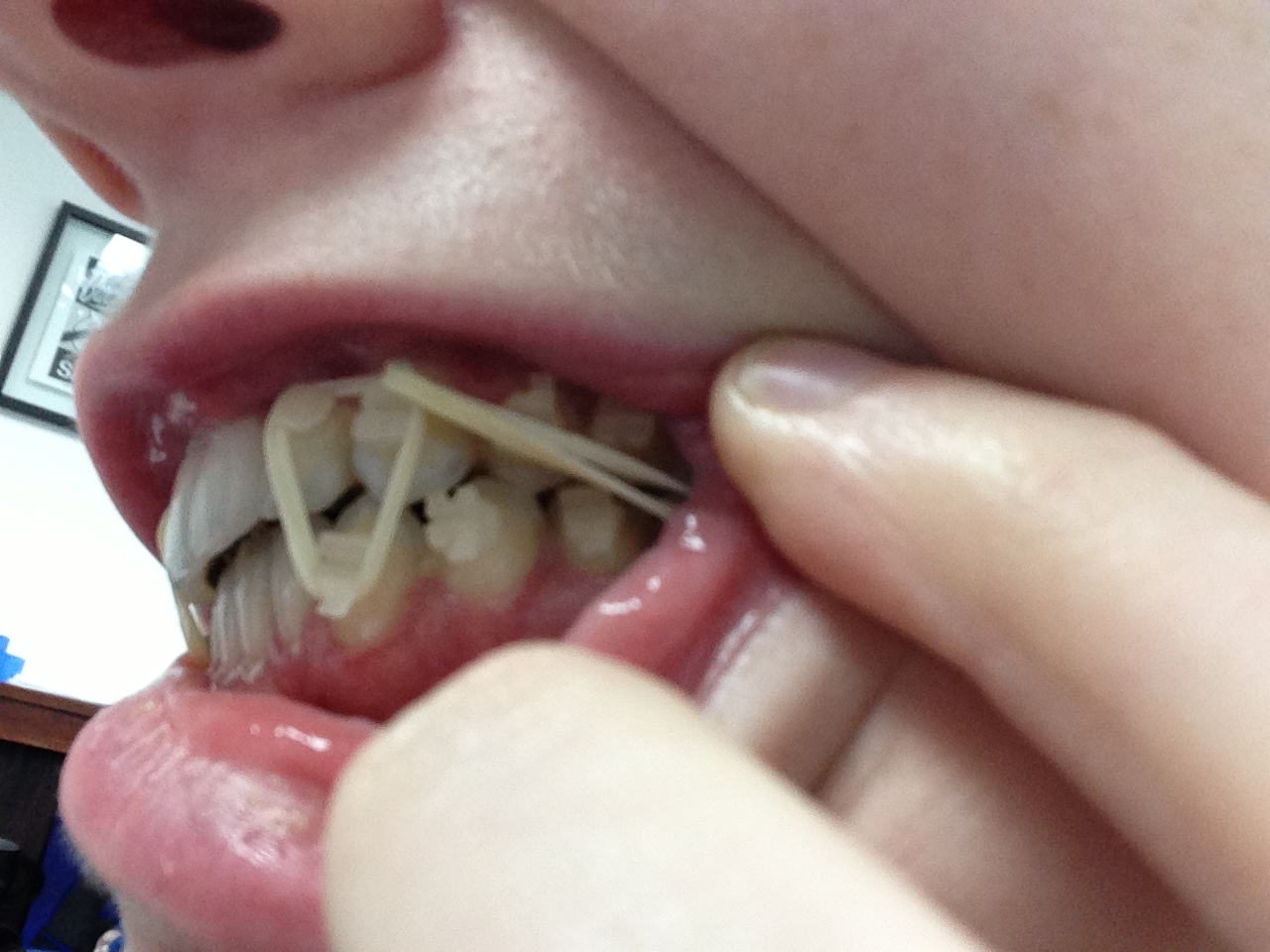 elastics bite overjet open surgery braces side class lingual orthodontic fix triangle ii elastic weeks treatment until close wear start