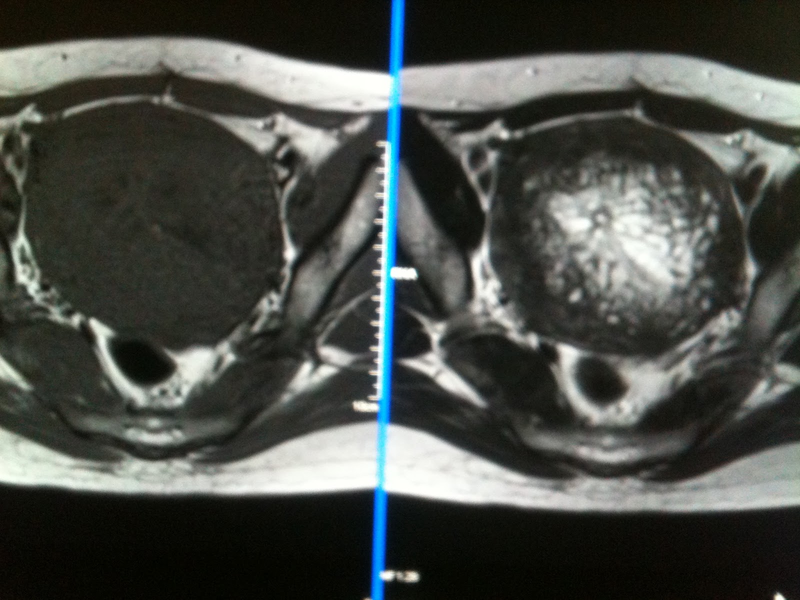 Endometrial Hyperplasia Versus Endometrial Cancer Sumer's Radiology Blog