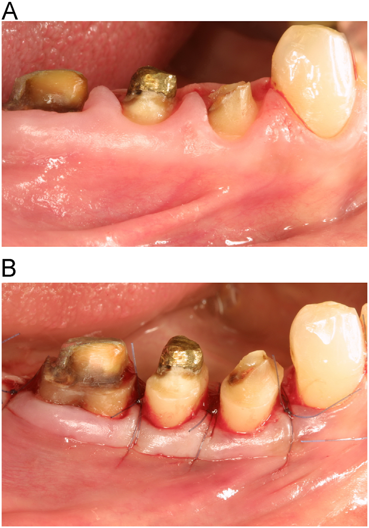 Crown lengthening procedures A literature review 2014 (seminars in