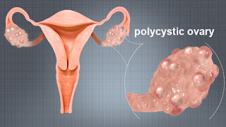 Early Signs and Symptoms of Pcos