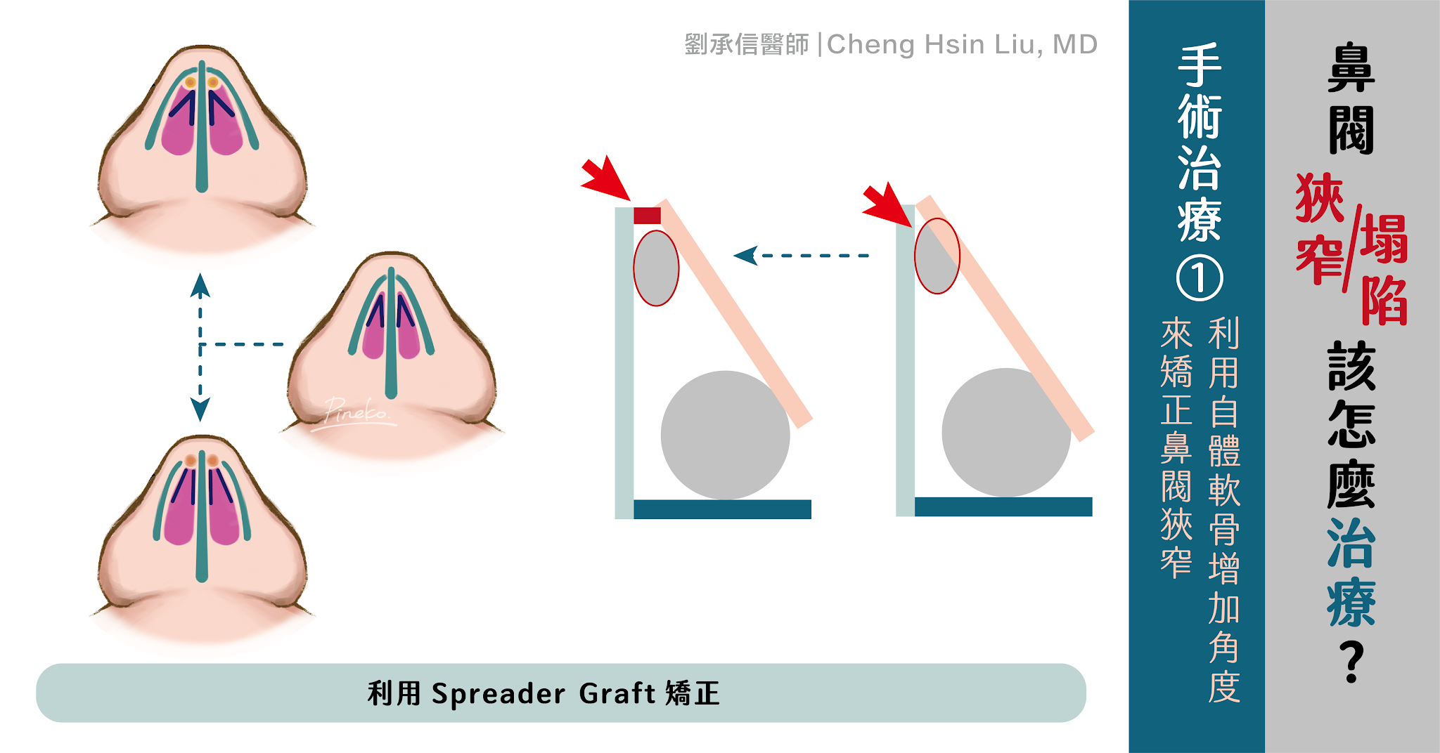 Spreader Graft：針對內鼻閥狹窄非常好用，甚至可以部分支撐鼻中隔過軟的問題，因此也廣泛用在結構式隆鼻當中。