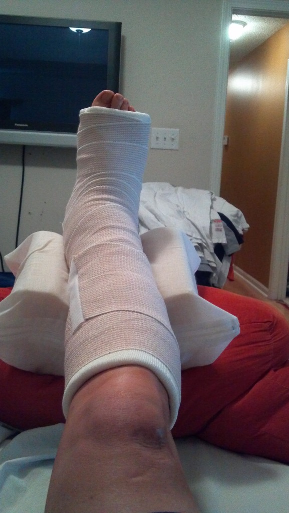 Chris' peroneal tendon surgery SURGERY