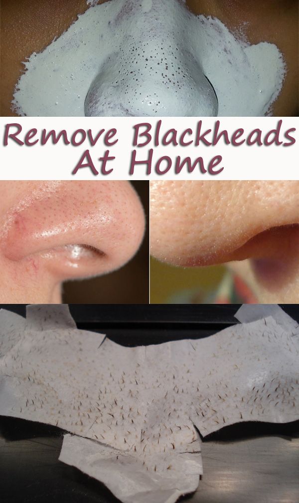 Remove Blackheads in a Natural Way Health, Fitness, Beauty Remedies