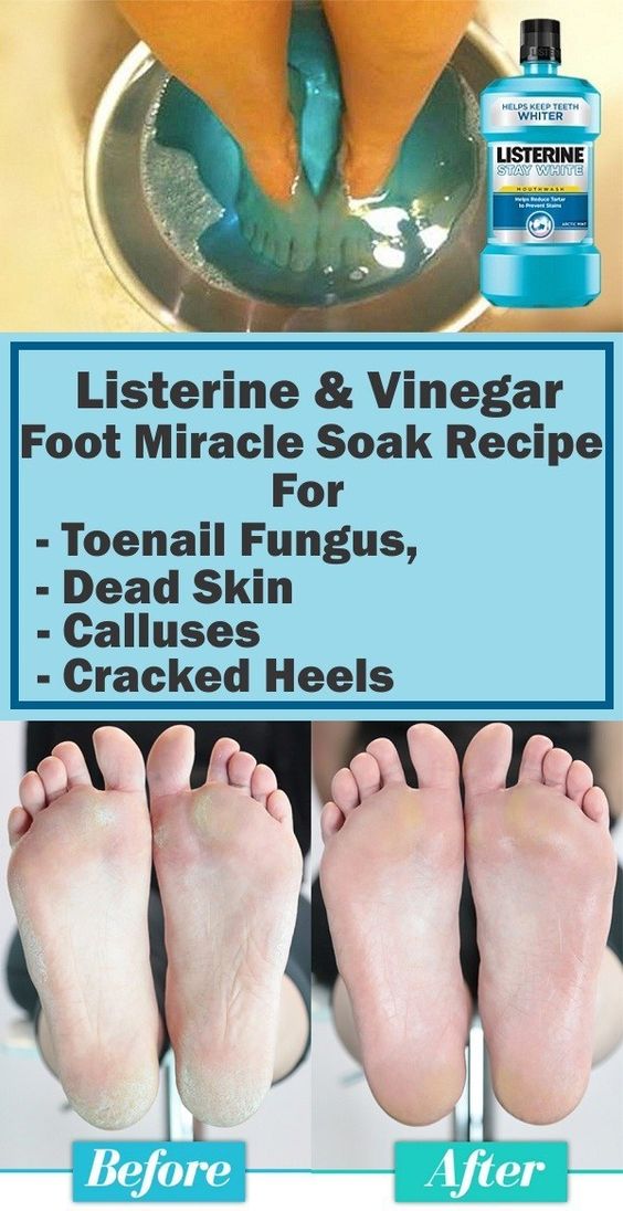 how to use vinegar for foot fungus Listerine & vinegar foot miracle ...
