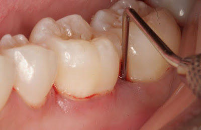 Tìm ra các nguyên nhân gây sưng nướu răng hàm trên 2