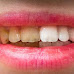 4 Homemade recipes to remove tartar, gingivitis and make your teeth whitened