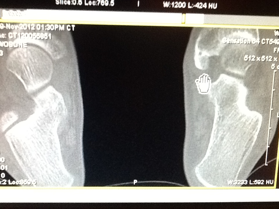 Foot and Ankle Problems By Dr. Richard Blake Images for Os Navicularis Accessory Navicular