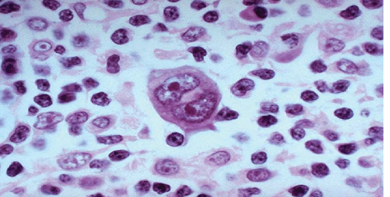 Linfoma de hodgkin celularidad mixta tratamiento