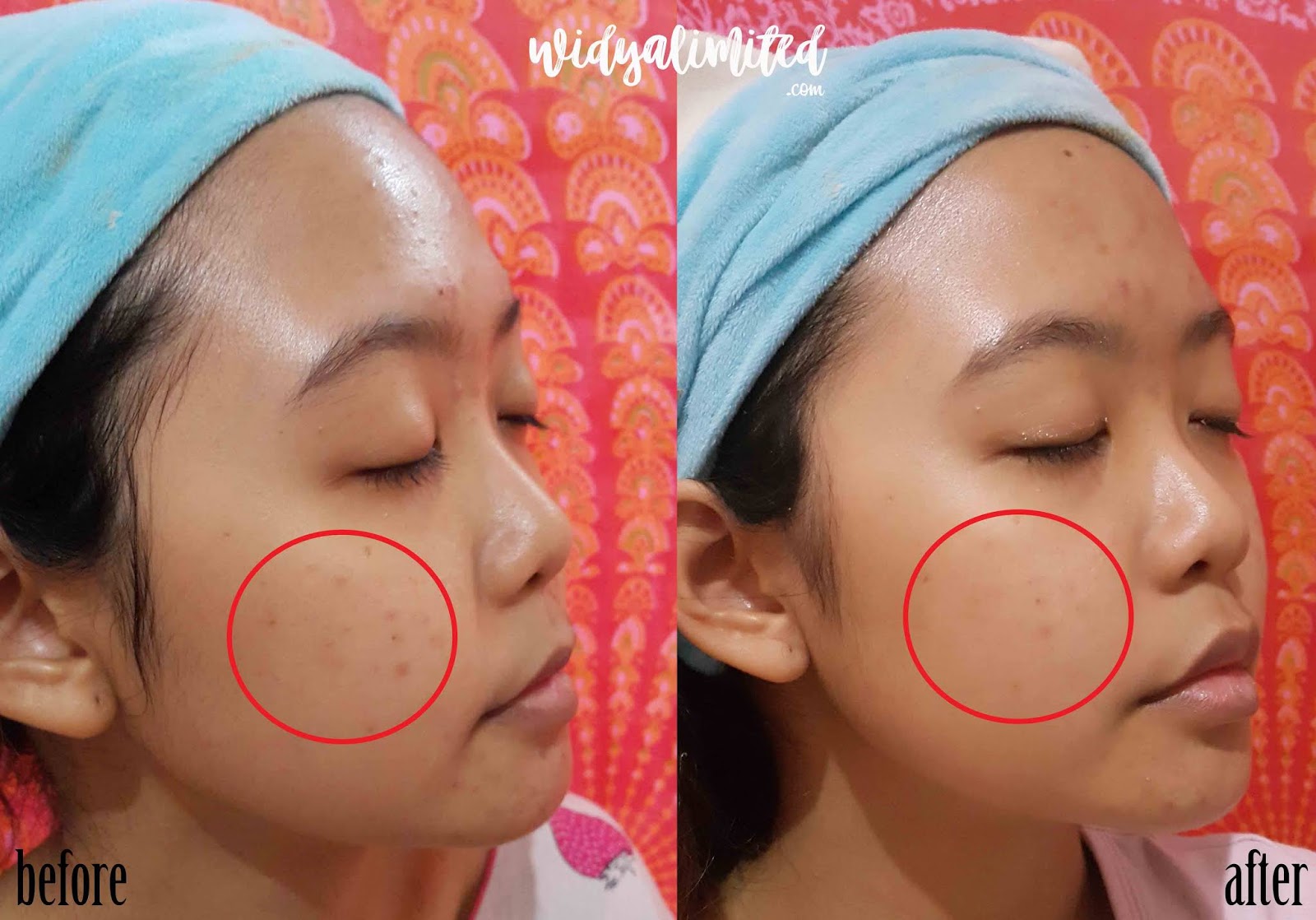 Honest Review Suplemen H2 Pure Skin Bisa Menyembuhkan Jerawat Bahasa Indonesia Widyalimited